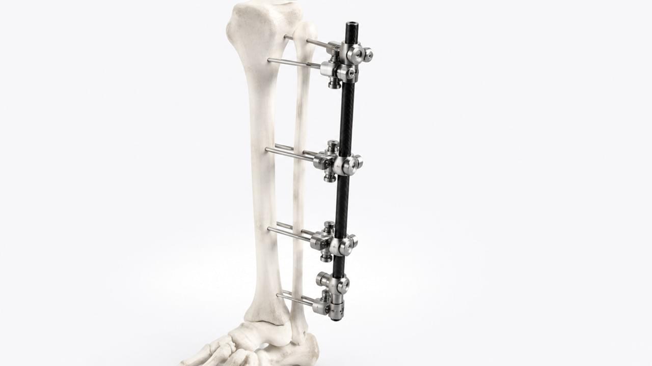 External fixator orthopedic trauma device monolateral system tibial fracture stabilization